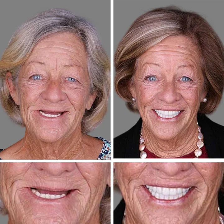 🎁 LUMIVO™ Premium Denture Set – Upper & Lower Dentures
