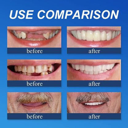 🎁 LUMIVO™ Premium Denture Set – Upper & Lower Dentures