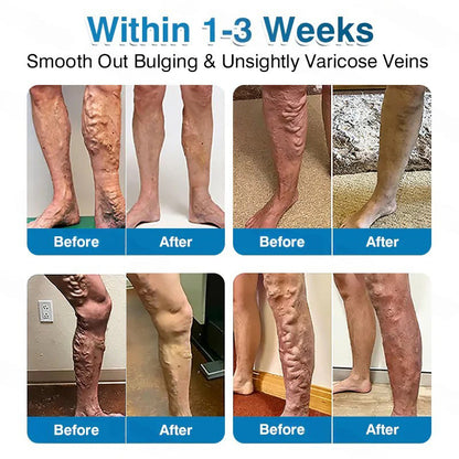 🇺🇸🏅🛡️Pryxo™ VeinRepair Microneedle Patch Roll⚡Instant Relief, Long-Term Results