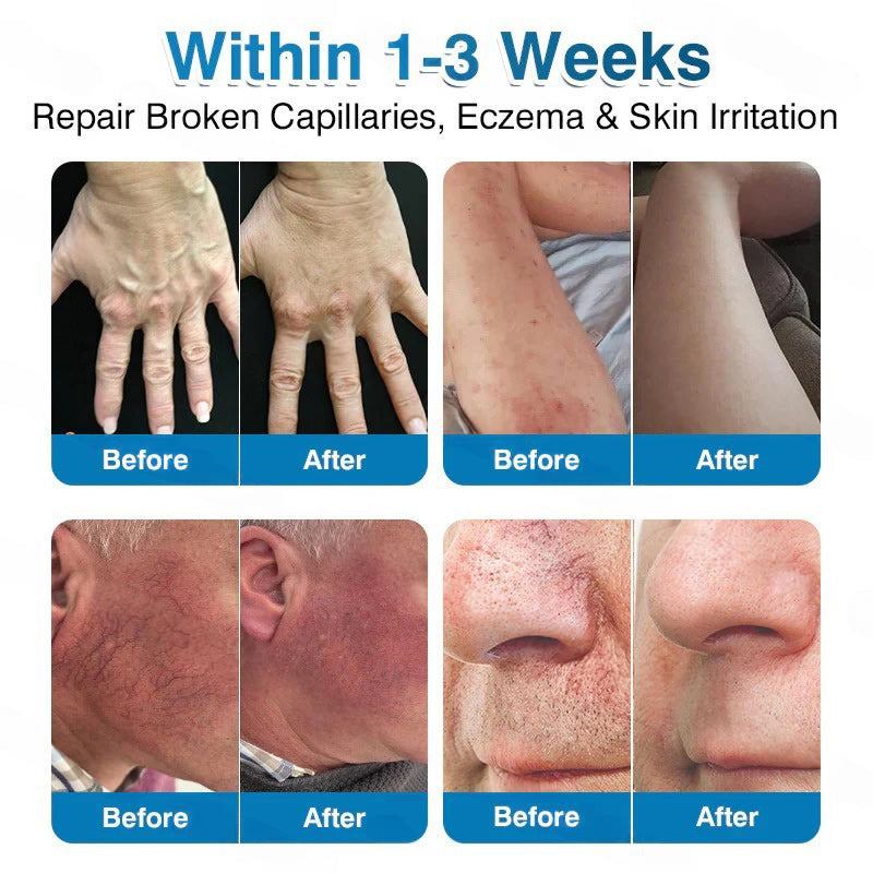 🇺🇸🏅🛡️Pryxo™ VeinRepair Microneedle Patch Roll⚡Instant Relief, Long-Term Results