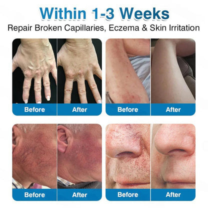 🇺🇸🏅🛡️Pryxo™ VeinRepair Microneedle Patch Roll⚡Instant Relief, Long-Term Results